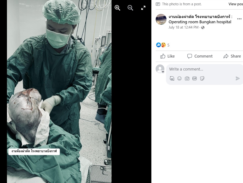 卵巣腫瘍は通常、サクランボほどの大きさで、この女性のように大きくなることは珍しい。一方で腫瘍が巨大になると、頻尿、腹痛、便秘、腹部膨満感といった症状に悩まされるようになるという（画像は『งานห้องผ่าตัด โรงพยาบาลบึงกาฬ : Operating room Bungkan hospital　2023年7月18日付Facebook「17/07/2566  TAH ＆ BSO」』のスクリーンショット）