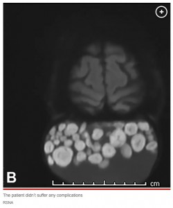 RSNAが公開したMRIスキャンの画像には、まるで無数のビー玉が入った袋のようにも見える女性の嚢腫が写っていた（画像は『New York Post　2023年7月26日付「Woman has ‘sack of marbles’ growing on scalp since childhood removed」（IMAGE: RSNA）』のスクリーンショット）