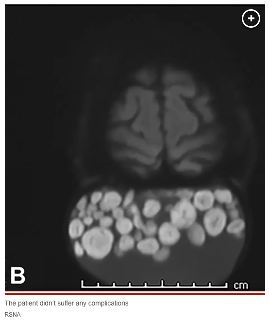 RSNAが公開したMRIスキャンの画像には、まるで無数のビー玉が入った袋のようにも見える女性の嚢腫が写っていた（画像は『New York Post　2023年7月26日付「Woman has ‘sack of marbles’ growing on scalp since childhood removed」（IMAGE: RSNA）』のスクリーンショット）