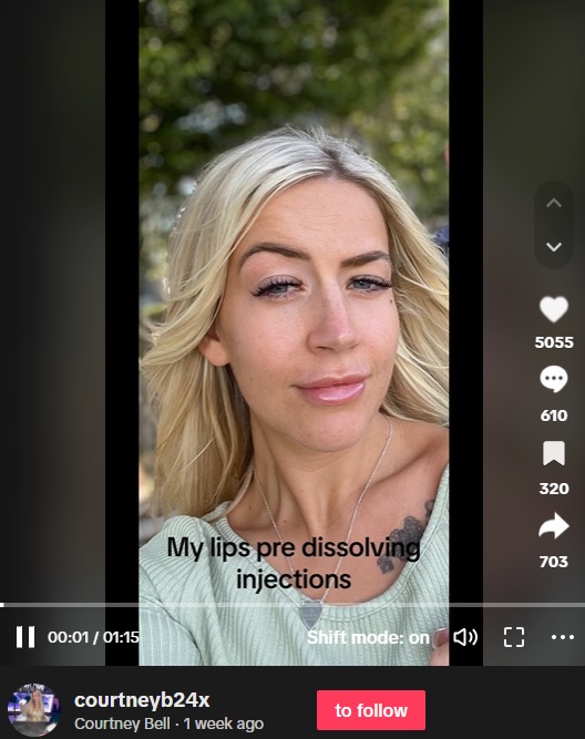 サロンでリップフィラーを溶解する施術を受ける前のコートニー・ターフェさん（27）。アレルギーを判定するパッチテストは受けたのだが…（画像は『Courtney Bell　2023年9月13日付TikTok』のスクリーンショット）
