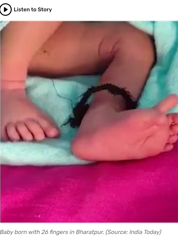 足指が6本ずつある女児。小指側に余剰指が生えているようだが、健康には全く問題はないという（画像は『India Today　2023年9月17日付「Baby born with 26 fingers in Rajasthan, family calls her incarnation of goddess」（Source: India Today）』のスクリーンショット）