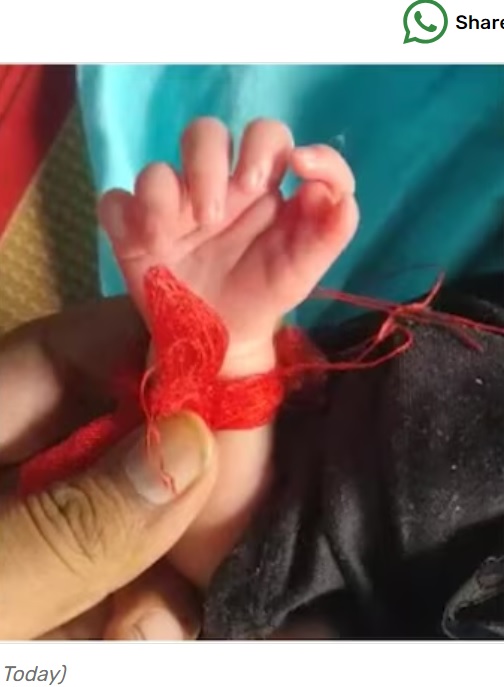 手指が7本ずつある女児。手の親指側に余剰指が2本ずつあるように見える。多指（趾）症は、胎児の手指や足指が分離する過程で指が多く作られるもので、原因は解明されていないという（画像は『India Today　2023年9月17日付「Baby born with 26 fingers in Rajasthan, family calls her incarnation of goddess」（Source: India Today）』のスクリーンショット）