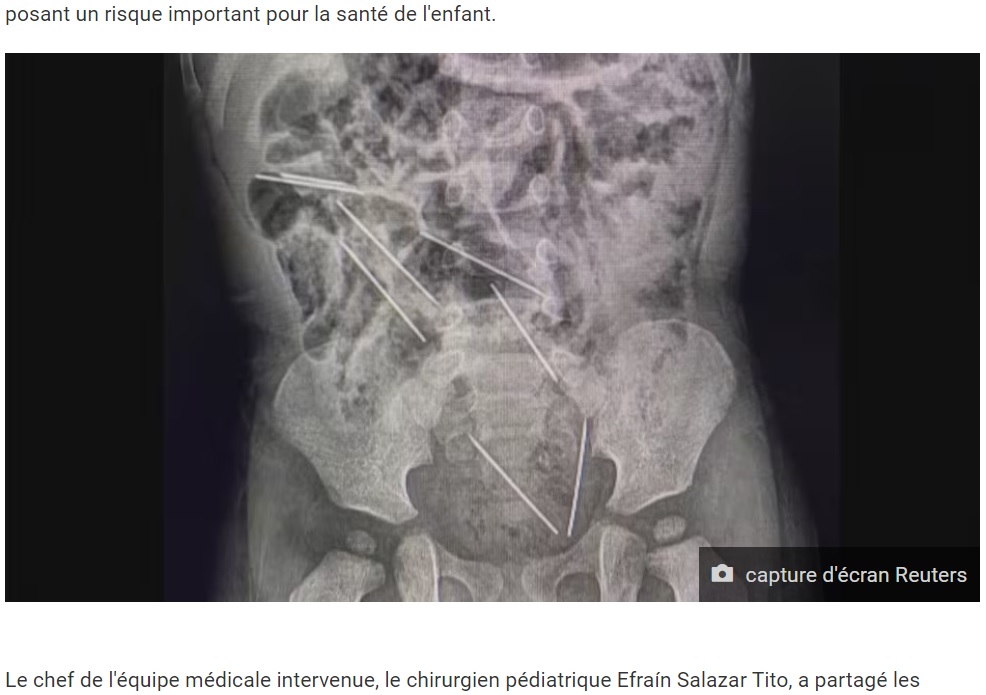 8本の注射針が写ったレントゲン写真。膀胱と直腸の間に2本の針があり、男児は危険な状態だった（画像は『TVA Nouvelles　2023年9月13日付「Un enfant qui a avalé 8 aiguilles médicales sauvé par les médecins」（capture d’écran Reuters）』のスクリーンショット）