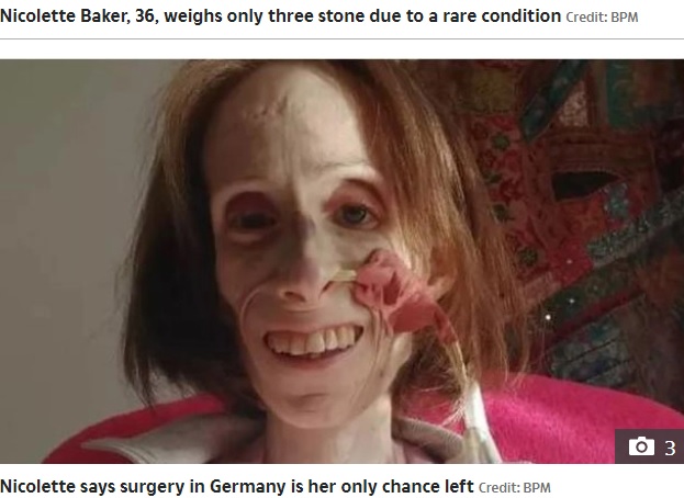 36歳で体重が約20キロしかないイギリスの女性。稀な疾患「上腸間膜動脈症候群」と判明し、手術を受けるため2022年にクラウドファンディングサイトで寄付を呼びかけていた（画像は『The Sun　2022年1月7日付「FIGHT FOR LIFE I weigh just 3 stone at 36 as rare condition is starving me to death」（Credit: BPM）』のスクリーンショット）