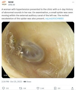 女性の耳の中を動き回っていた小さなクモ。さらに耳の中で脱皮をしたようで、その抜け殻がクモのそばに落ちていた（画像は『NEJM　2023年10月25日付X「A woman with hypertension presented to the clinic with a 4-day history of abnormal sounds in her ear.」』のスクリーンショット）