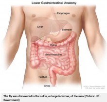 【海外発！Breaking News】大腸カメラ検査で患者の腸に無傷のハエを発見　「非常に珍しいケース」と医師（米）