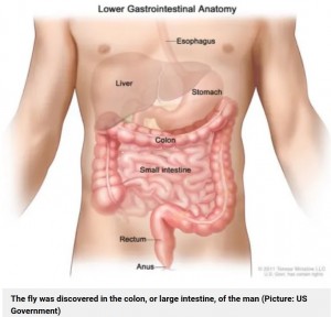 【海外発！Breaking News】大腸カメラ検査で患者の腸に無傷のハエを発見　「非常に珍しいケース」と医師（米）
