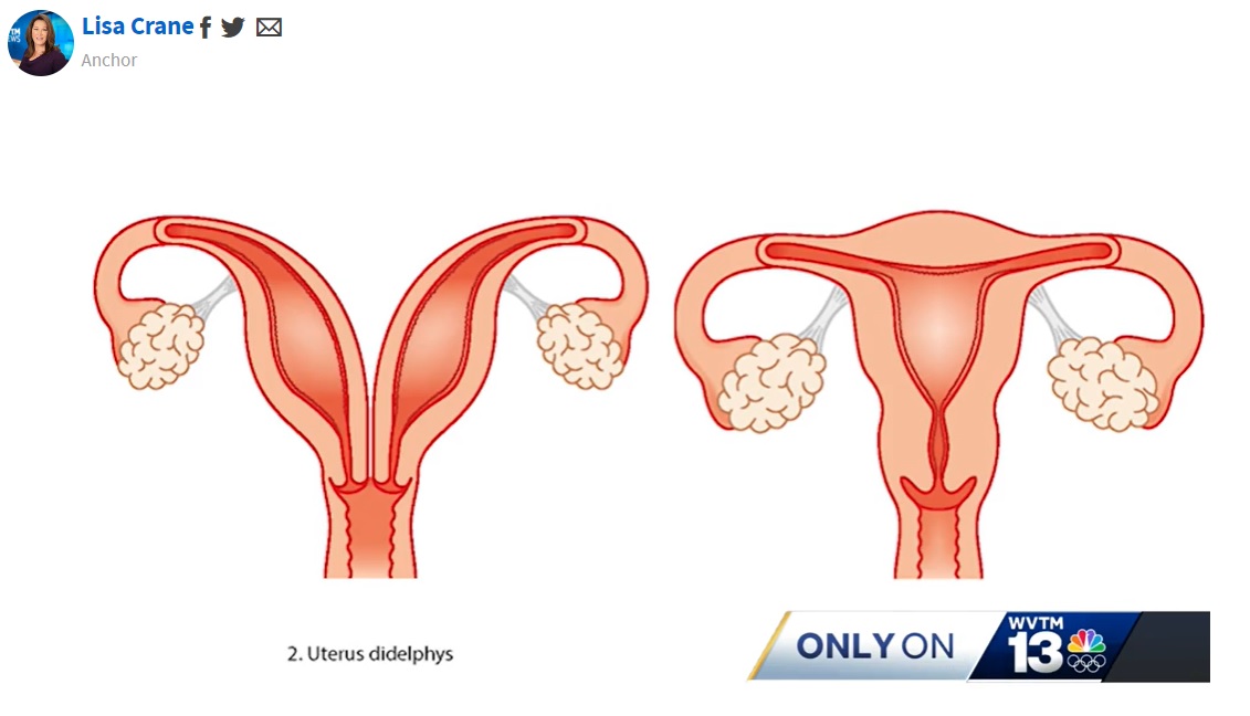 ケルシーさんの子宮の図（左側）。2つの子宮と2つの子宮頸部を持つ場合、出産のリスクが高いと予想されている（画像は『WVTM 13　2023年11月10日付「Dora mom with double uterus pregnant in both」』のスクリーンショット）