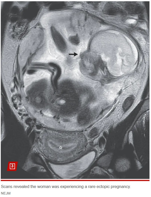 子宮外に受精卵が着床する、異所性妊娠（子宮外妊娠）と判明した女性。腹腔内に着床するという珍しいケースだったが、母子ともに順調に回復して退院することができた（画像は『New York Post　2023年12月12日付「Woman’s stomach cramps turn out to be a baby — in her bowel」（NEJM）』のスクリーンショット）