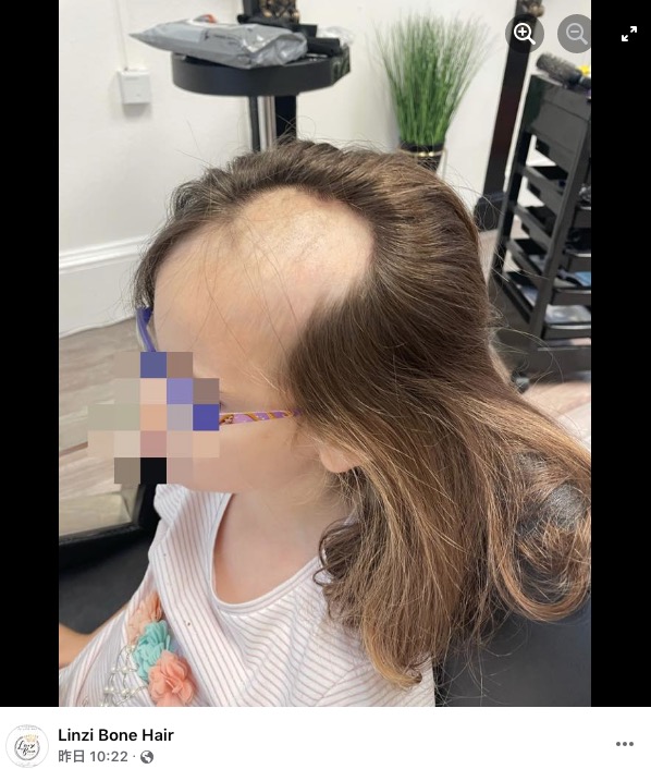 スコットランドのある家庭で2021年10月、5歳女児の髪の毛が電動ミキサーに絡まってしまう事故が発生。前頭部の髪がごっそり引き抜かれてしまった（画像は『Linzi Bone Hair　2021年10月28日付Facebook「Met theee most amazingly brave 5 year old」』のスクリーンショット）