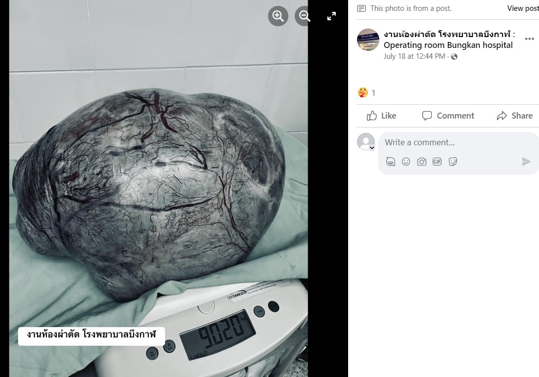 タイの病院で今年7月、体重増加で悩んでいた女性の卵巣から巨大な腫瘍が摘出された。腫瘍はまるで光る岩のようで、9キロ超もあったという（画像は『งานห้องผ่าตัด โรงพยาบาลบึงกาฬ : Operating room Bungkan hospital　2023年7月18日付Facebook「17/07/2566 TAH ＆ BSO」』のスクリーンショット）