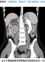 【海外発！Breaking News】「水をほとんど飲まなかった」20歳女性の腎臓から300個以上の結石を回収（台湾）