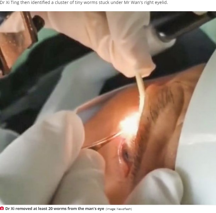 中国江蘇省にある病院を訪れた男性の右瞼の裏から、白くて細長い寄生性線虫約20匹が摘出された。男性は1年以上前から右目に違和感があったそうだ（画像は『Daily Star　2020年10月26日付「Stomach-churning moment doctor removes 20 live worms from man’s eyelid」（Image: Newsflash）』のスクリーンショット）