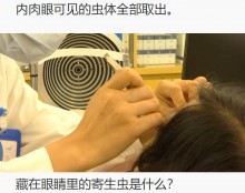 【海外発！Breaking News】女性の両目に蠢く糸状の寄生虫！　60匹以上摘出で医師驚愕（中国）＜動画あり＞