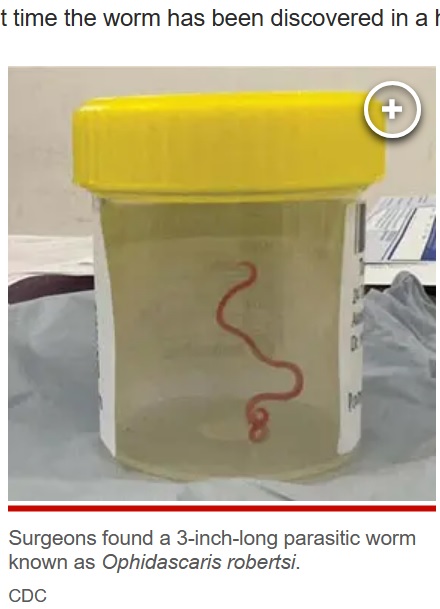 オーストラリアの病院で2022年6月、患者の脳から生きた寄生虫が摘出された。摘出された寄生虫は通常ニシキヘビに寄生しているものと判明し、ヒトに寄生した世界で初めての症例だった（画像は『New York Post　2023年8月28日付「Worm discovered living in woman’s brain in world’s first case: ‘It’s alive!’」（CDC）』のスクリーンショット）