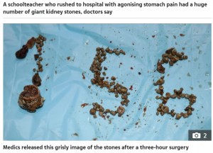 インド在住の50歳男性が2021年、激痛で病院に駆け込む。担当医が検査を行ったところ、腎臓に多くの結石があることが判明し、156個の結石を摘出していた（画像は『The Sun　2021年12月18日付「PEBBLE SCREECH Man, 50, has ‘record-breaking’ 156 kidney stones removed by docs during 3-hour surgery after agonising stomach pain」』のスクリーンショット）