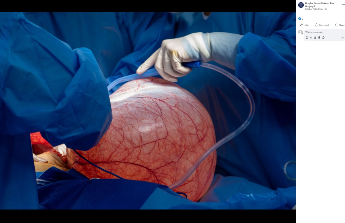 エクアドルの病院で今年10月、43歳の女性の腹部から重さ13キロの卵巣腫瘍が摘出される。女性は体重増加に悩んでいたという（画像は『Hospital General Monte Sinaí Guayaquil　2023年10月7日付Facebook「＃BolletínDePrensa」』のスクリーンショット）