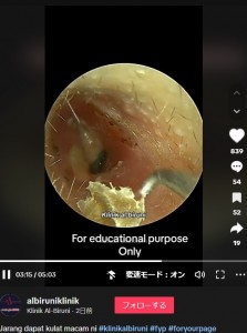 外耳道から目玉焼きのようなカビを取り出した後。奥の粘膜もヨーグルト状の塊で覆われ、出血しているようにも見えた。医師によると鼓膜が腫れていたという（画像は『Klinik Al-Biruni　2023年1月7日付TikTok「Jarang dapat kulat macam ni」』のスクリーンショット）