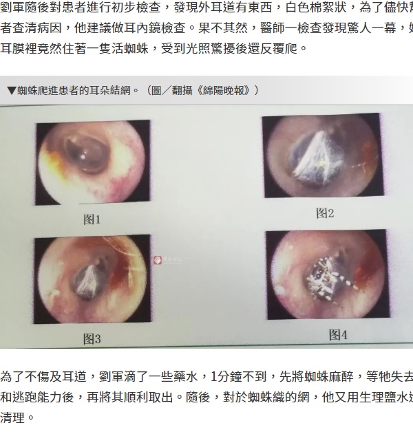 中国四川省の病院で2020年、女性患者の耳から生きたクモが摘出される。クモは耳の中で糸を張り、活発に動いていた（画像は『ETtoday新聞雲　2020年4月26日付「她耳鳴一周檢查驚見「白色棉絮狀」　光一照還到處爬…醫曝真相」（圖/翻攝《綿陽晚報》）』のスクリーンショット）