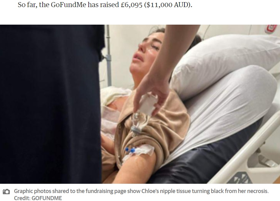 費用が安いトルコで、伸びた皮膚を切除して下垂した乳房を持ち上げる「乳房リフト手術」を受けた22歳の女性。約52万6000円を支払ったが、術後に異変が起きる（画像は『PerthNow　2024年1月20日付「Chloe Rose: UK mum’s boob job in Turkey goes terribly wrong, develops necrosis from dying nipple tissue」（Credit: GOFUNDME）』のスクリーンショット）