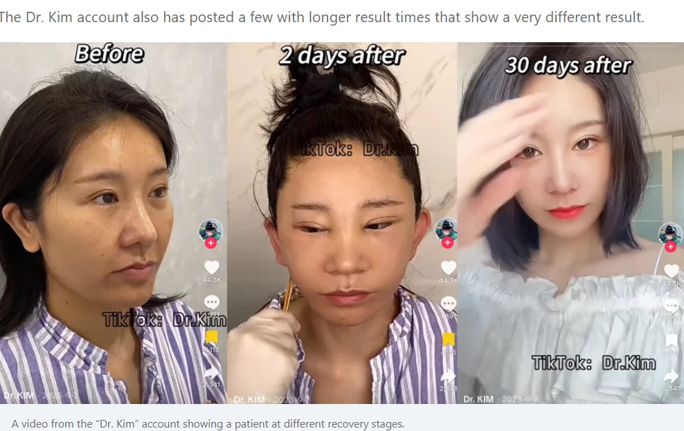 ドクター・キムの動画の中には珍しく、施術から30日後の女性の姿も投稿されており、「実はそれほど悪くはないのでは？」という感想も届いている（『Koreaboo　「TikTok’s Dr. Kim Goes Viral For “Botched” Plastic Surgery Results, Unlocking A Twisted Back Story」』より）