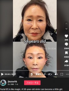 フェイスリフトは魔法？　58歳女性のビフォーアフター。全く別人のようで「芸能人はこれをしているの？」といった声もあった（『Dr. KIM　TikTok「Facial lift is like magic」』より）