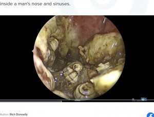 耳鼻咽喉科のカールソン医師が鼻の中にカメラを入れて検査したところ、無数の幼虫が蠢いているのが観察できた。鼻の中は炎症を起こしていたという（『First Coast News　「150 live bugs removed from inside of man’s face at Jacksonville hospital」』より）