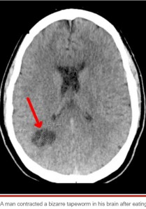 感染症専門家らは有鉤条虫の幼虫が脳内に達した病態である「神経嚢虫症」との診断を下した。男性が病院を訪れる前の4か月間は片頭痛が特に酷くなったという（『New York Post　「Florida man complains of migraines ― docs find tapeworm in his brain from eating undercooked bacon」』より）