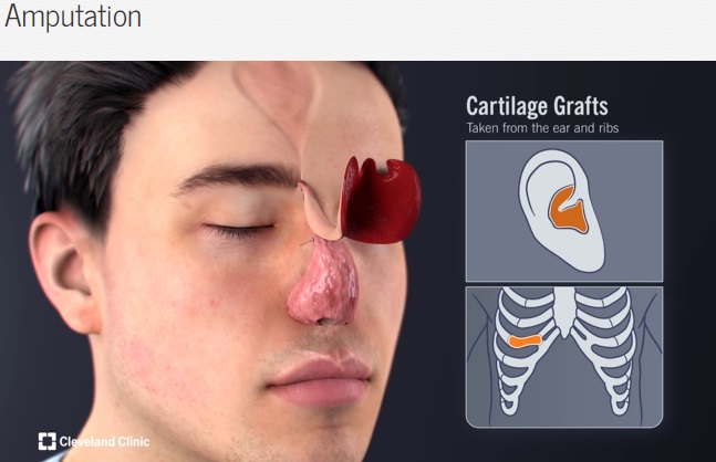 4年に及ぶ手術では、肋軟骨、軟骨を含む耳介皮弁、前額皮弁などが使われ、そのほとんどがアンドリューさん自身の組織から再建された（『Cleveland Clinic　「Complete Nose Reconstruction Restores Man’s Confidence After Amputation」』より）