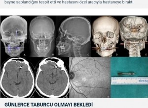 CTスキャン検査では、スクリューが上顎を突き抜けて、脳脊髄液まで到達していることが判明。3人の医師が手術をすることを拒否したという（『NTV Haber　「İmplant tedavisinde vida beynine saplandı: Yanlış tedavi hayatını kararttı」』より）