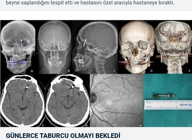 CTスキャン検査では、スクリューが上顎を突き抜けて、脳脊髄液まで到達していることが判明。3人の医師が手術をすることを拒否したという（『NTV Haber　「İmplant tedavisinde vida beynine saplandı: Yanlış tedavi hayatını kararttı」』より）
