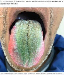 医学雑誌『ニューイングランド・ジャーナル・オブ・メディシン』に2023年7月、舌が緑色に変色し、毛が生えたようになった米オハイオ州の64歳喫煙者のケースが掲載された（『news.com.au　「Smoker’s tongue turns green, spouts hair after rare reaction」（Picture: The New England Journal of Medicine）』より）