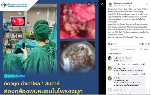 ナコンピン病院のFacebookに日本時間の今月2日に投稿されたウジ摘出の様子（左）。鼻の奥に多数のウジが潜んでいるのが分かり（右上）、100匹以上が摘出された（『โรงพยาบาลนครพิงค์　Facebook「คัดจมูกกำเดาไหล 1 สัปดาห์ นึกว่าเพราะฝุ่น PM 2.5 ส่องกล้องเจอหนอนในโพรงจมูกจำนวนมาก」』より）