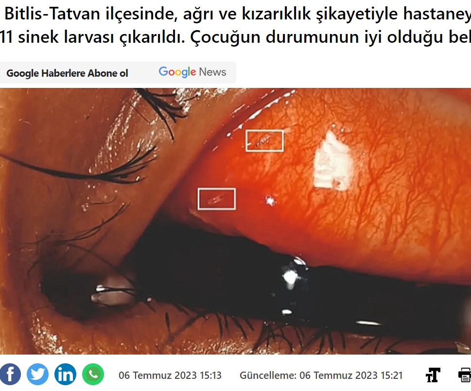 トルコの病院で2023年7月、10歳男児の左瞼の裏から11匹のウジが摘出された。医師によると、瞼の裏で幼虫が動き回っていたという（『MedyaTava　「10 yaşındaki çocuğun gözünden ne çıktı7」』より）