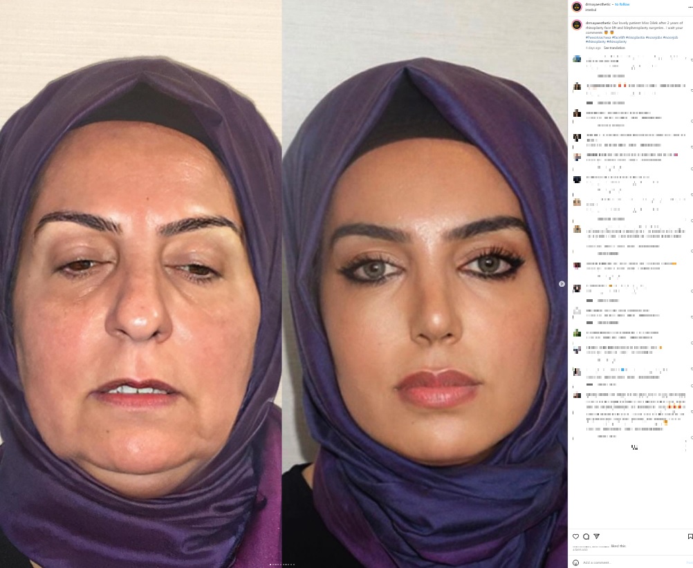 「Este Med Istanbul」が2023年9月にSNSへ投稿した68歳の女性の美容整形のビフォーアフター写真。「フェイクでは？」などと大炎上したが、美容外科手術に2年をかけたそうだ（『Dr. MAY Facial Plastic Surgery　Instagram「Our lovely patient Miss Dilek after 2 years of rhinoplasty face lift and blepheroplasty surgeries..」』より）