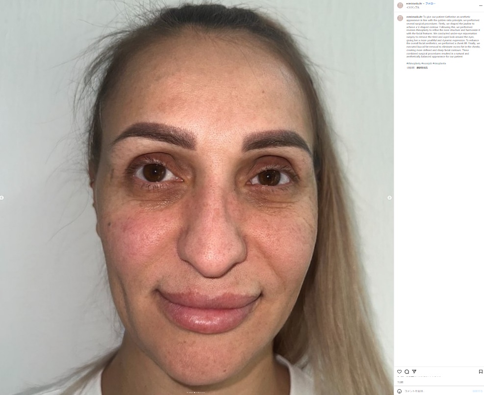 トルコのイスタンブールにある美容整形クリニックで手術を受けた女性。写真は手術前のもの（『Facial Plastic Surgery, Dental Treatment and Cosmetic Products　Instagram「To give our patient Katherine an aesthetic appearance in line」』より）