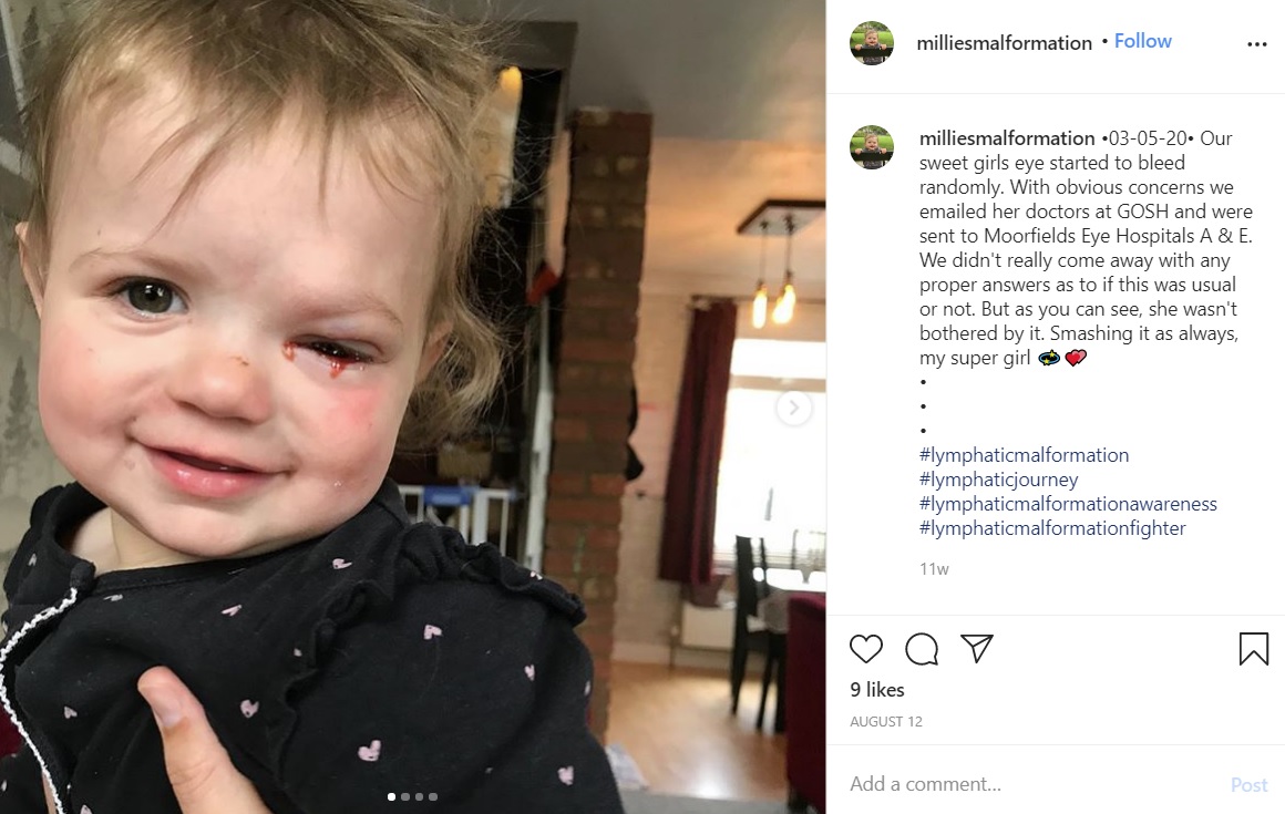 2020年5月に目から出血し、瞼が大きく腫れ上がってしまったイギリスの1歳女児。「リンパ管奇形」による症状だった（『Millies Lymphatic Malformation　Instagram「28-12-18　Our sweet girl」』より）