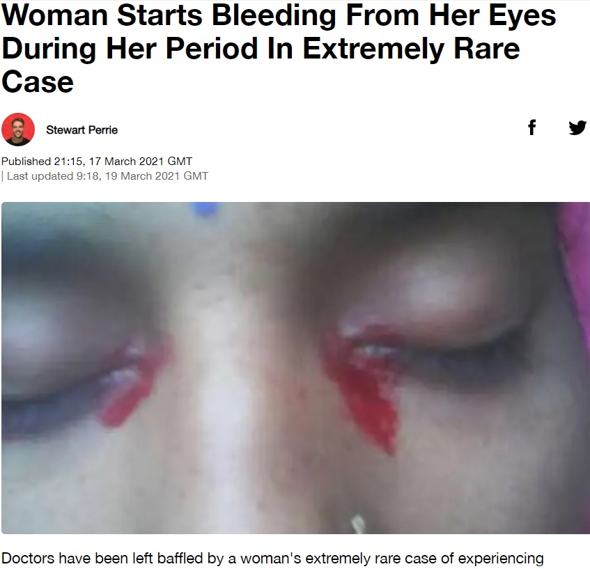 2021年3月、医学専門雑誌『BMJ』に報告された血の涙を流すインド在住の女性。彼女は生理の時に性器外から出血する「代償性月経」と診断されていた（『LADbible　「Woman Starts Bleeding From Her Eyes During Her Period In Extremely Rare Case」（Credit: BMJ）』より）