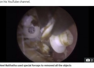 フィルターは柔らかいシリコン製で、いくつかは重なり合い、鼓膜に貼り付いていた。摘出は決して簡単ではなく、耳用微細吸引管と耳用鉗子を併用したという（『The Sun　「EAR WE GO Man has 22 objects removed from his ear - after they kept falling off his hearing aid」』より）