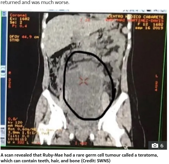 検査の結果、「奇形腫」と判明。緊急手術が行われ、約3.6キロの腫瘍が摘出された（『The US Sun　「HORROR FIND Girl, 12, who complained ‘my tummy hurts’ has 8lb tumour filled with hair, teeth and bones removed from stomach」（Credit: SWNS）』より）