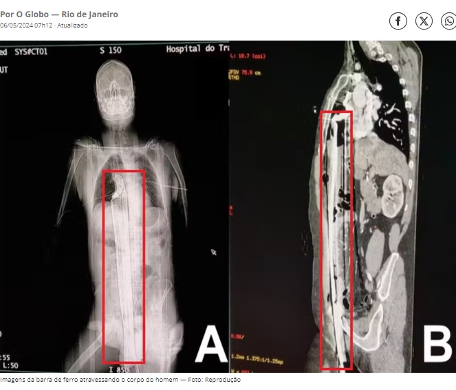男性のCTスキャン。肝臓と横隔膜の一部を貫通しているが、心臓は無事だった（『O GLOBO　「Curitibano cai de andaime e escapa da morte por pouco após barra de ferro de um metro atravessar seu corpo」（Foto: Reprodução）』より）