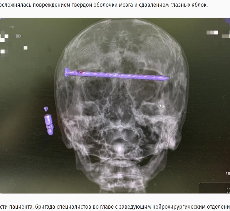 CTスキャンにより、男性の頭蓋骨には長さ15センチの釘が右側のこめかみ辺りから左側のこめかみに向けて水平に刺さり、左右両方の眼窩を突き刺した状態であることが判明した（『РИА Новый День　「Уральские врачи достали из головы 78-летнего мужчины 15-сантиметровый гвоздь」』より）